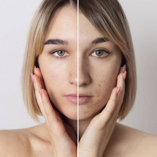 acne-products